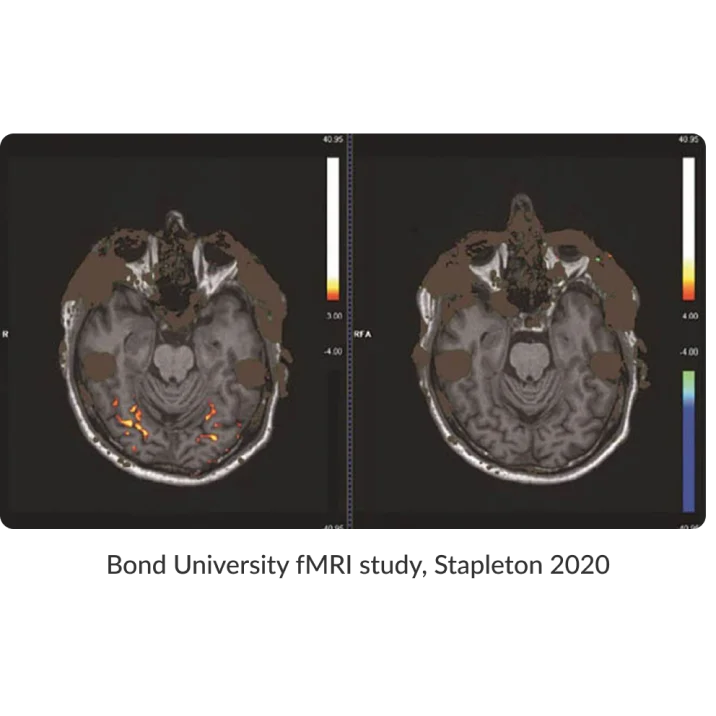 Bond University fMRI study, Stapleton 2020
